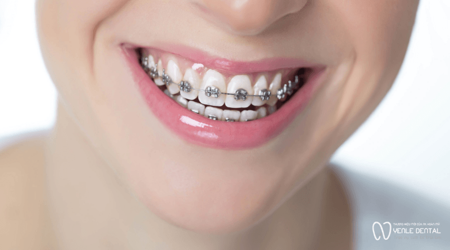 niềng răng mắc cài kim loại thường